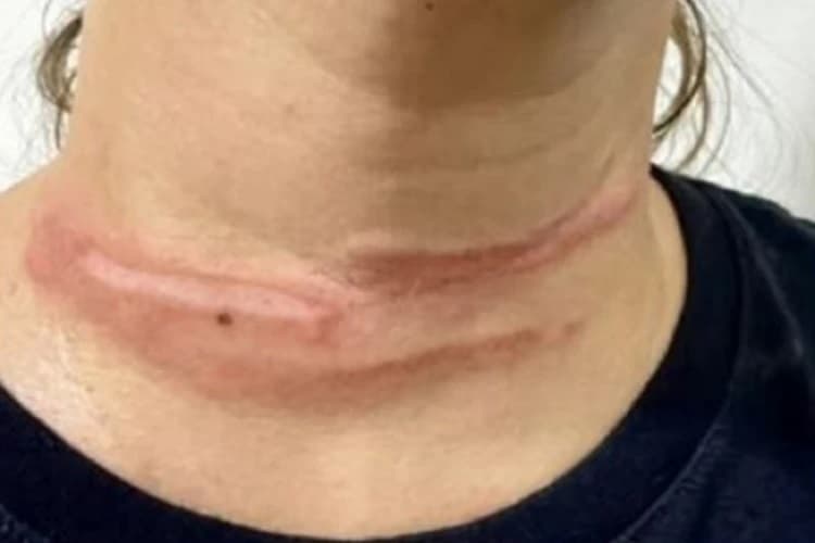 Mulher se fere após fio solto enroscar em pescoço em Livramento