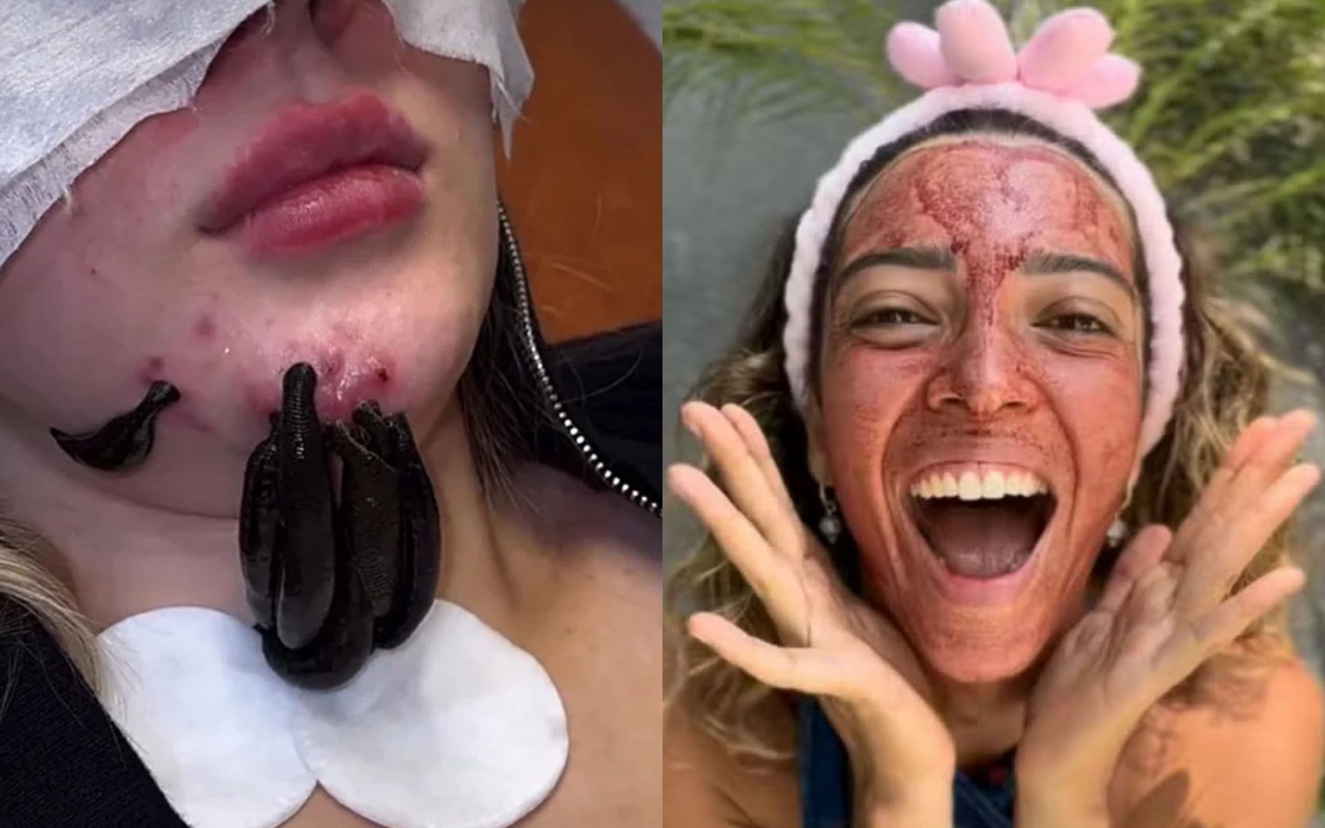 Bahia: Cresce busca por procedimentos estéticos perigosos com fluidos corporais