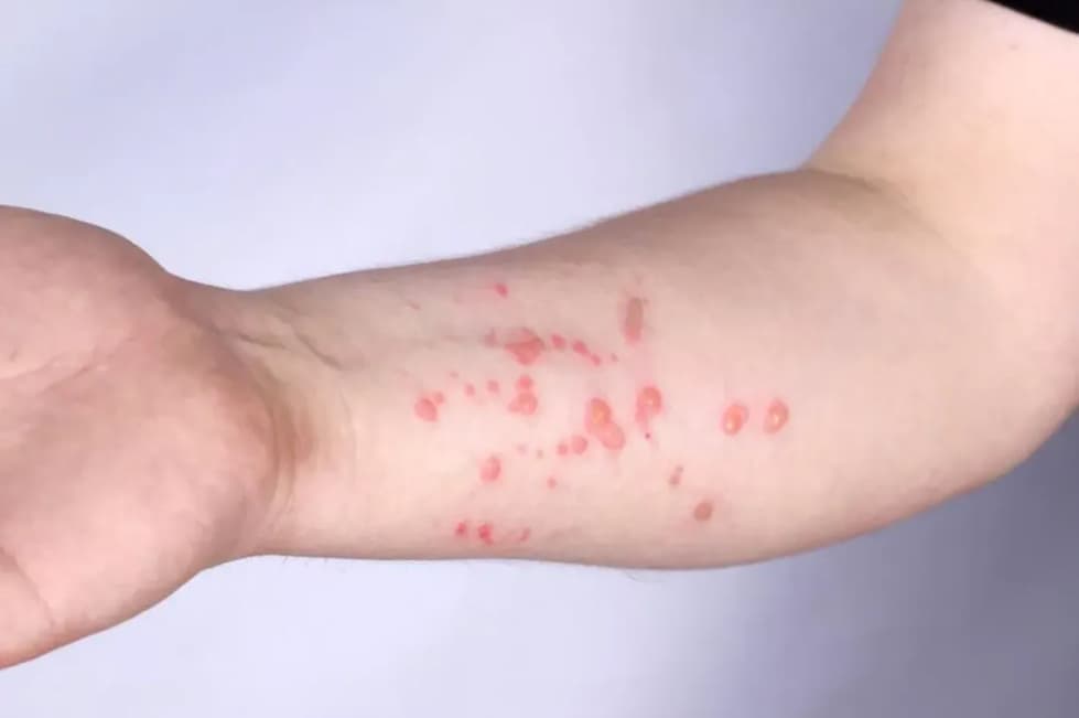 OMS alerta para nova variante mpox recombinante; antiviral não é eficaz