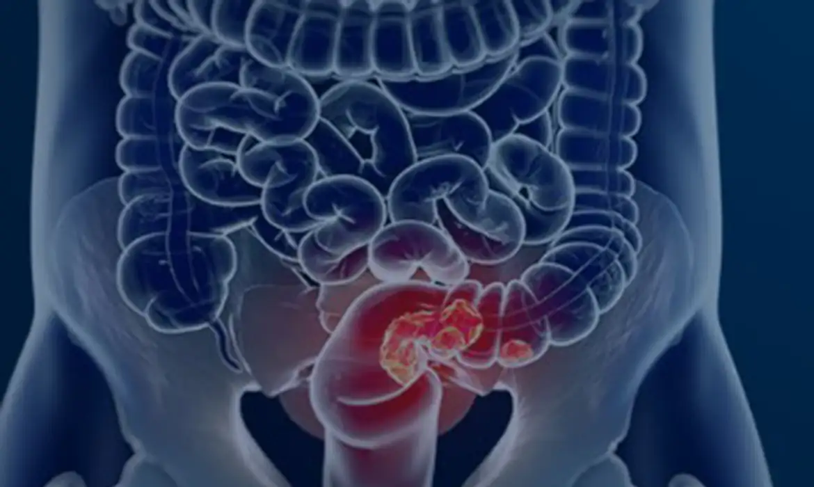 Câncer de intestino: Brasil terá 53,8 mil novos casos até 2028, alerta Inca